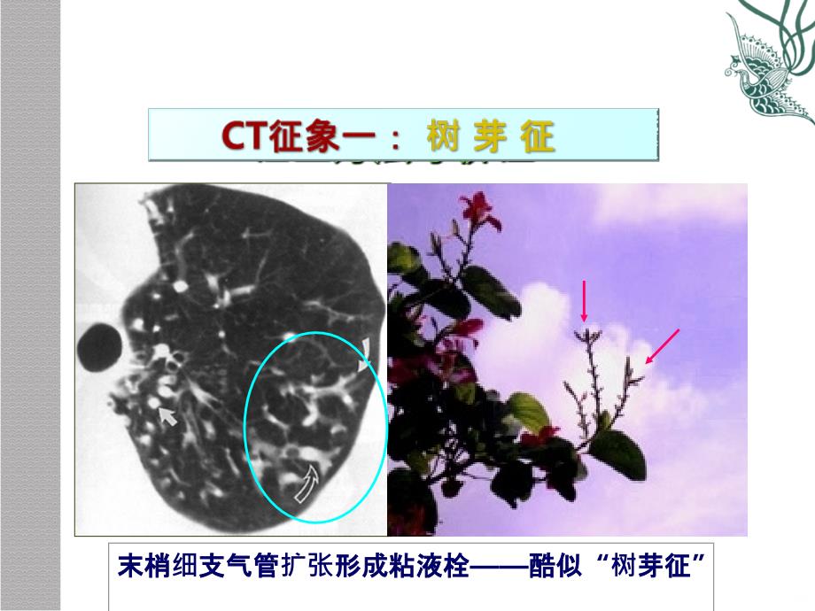 肺疾病的CT征象分析象PPT课件_第4页