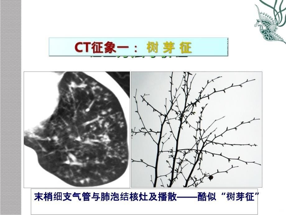 肺疾病的CT征象分析象PPT课件_第5页