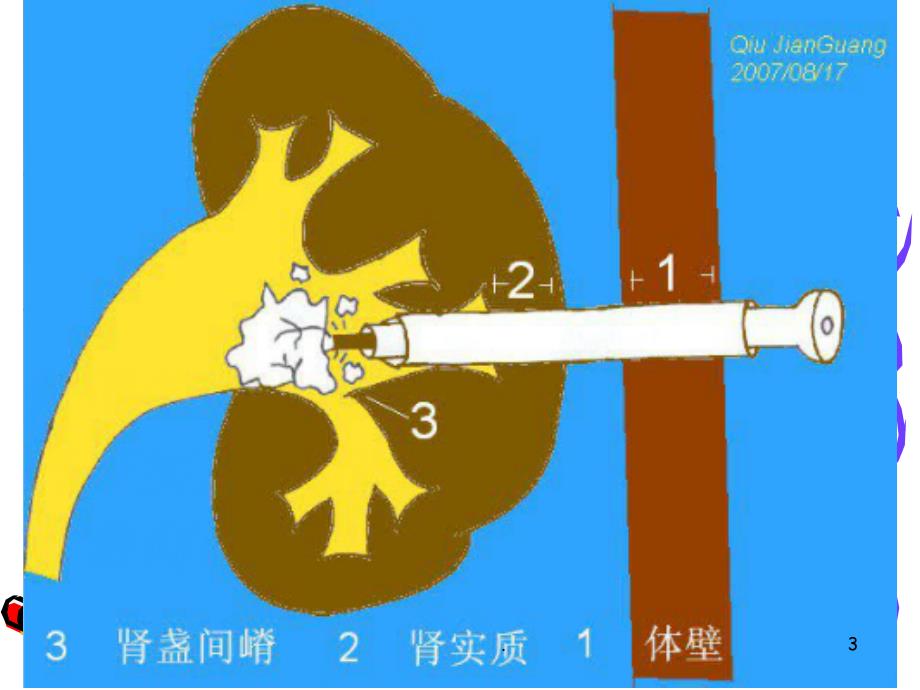 经皮肾镜碎石取石术精品PPT课件_第3页