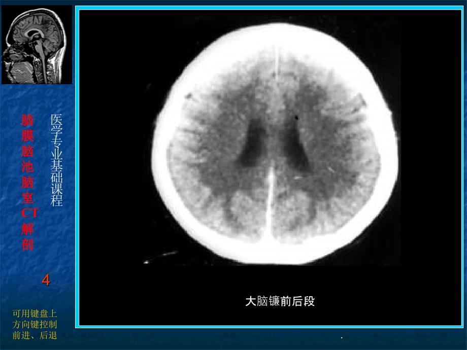 脑膜、脑池、脑室的CT解剖PPT课件_第4页