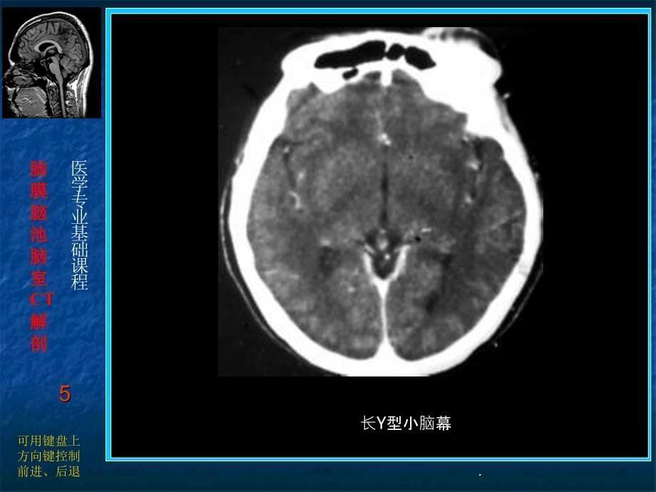 脑膜、脑池、脑室的CT解剖PPT课件_第5页