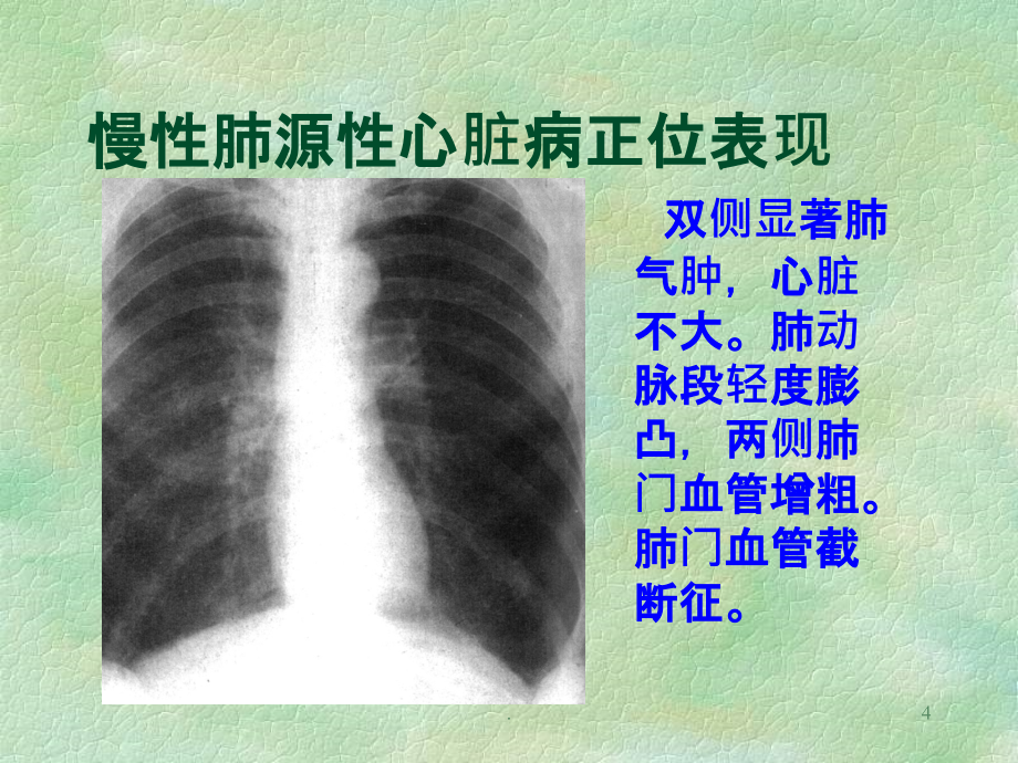 慢性肺源性心脏病精品PPT课件_第4页