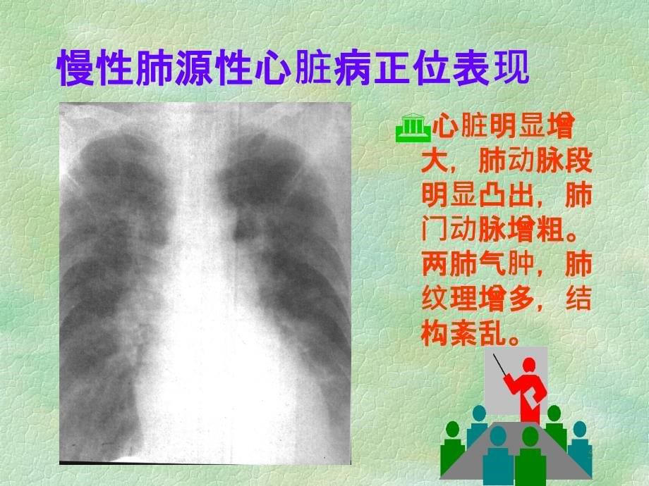 慢性肺源性心脏病精品PPT课件_第5页