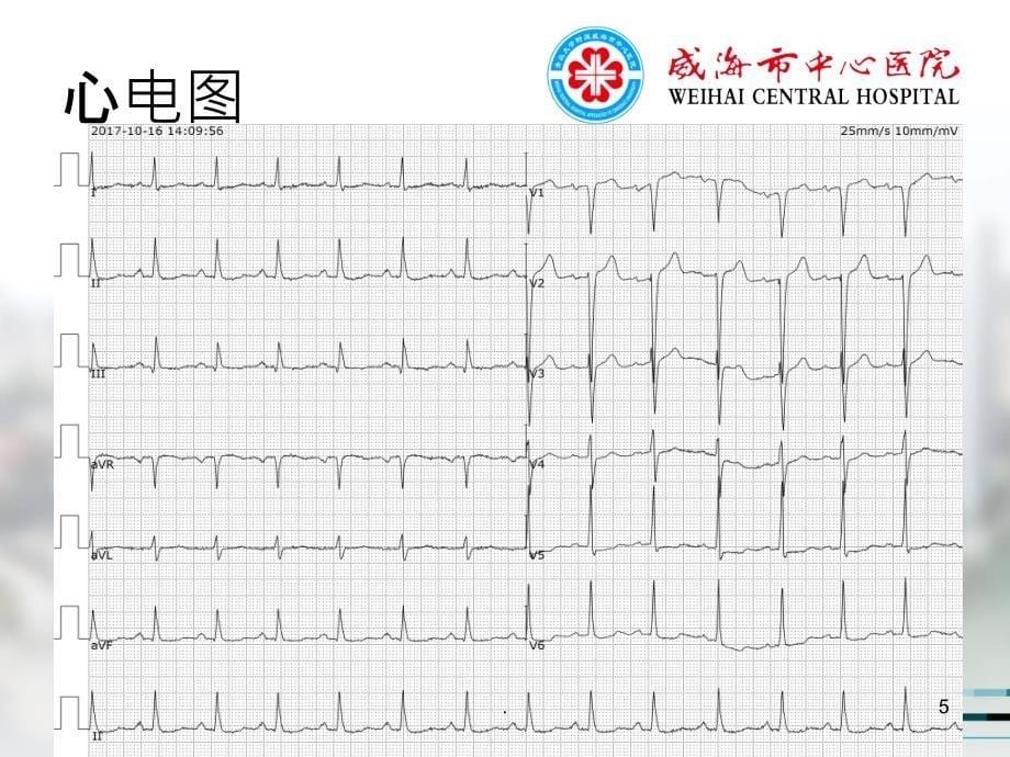 冠脉严重钙化病变处理一例PPT课件_第5页