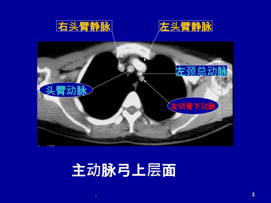 纵隔大血管CT表现PPT课件_第3页