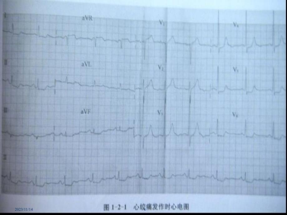 心绞痛、变异性心绞痛的心电图PPT课件_第4页