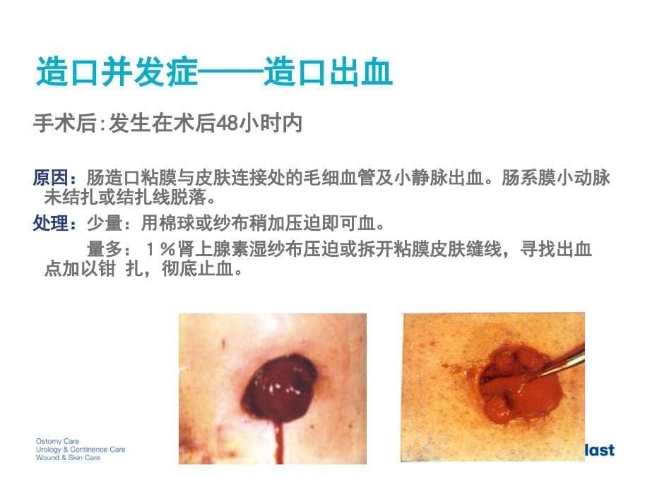 造口并发症的处理资料讲解_第5页