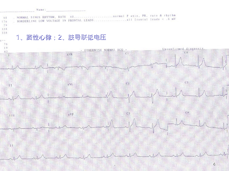 心电图图解PPT课件_第4页