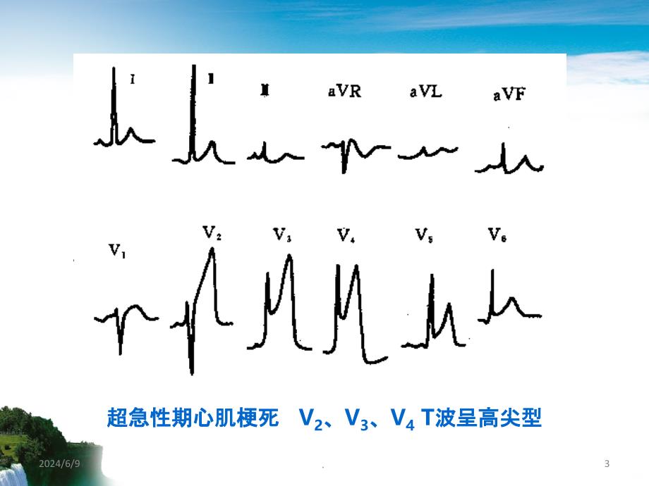 心肌梗死VS束支传导阻滞PPT课件_第3页