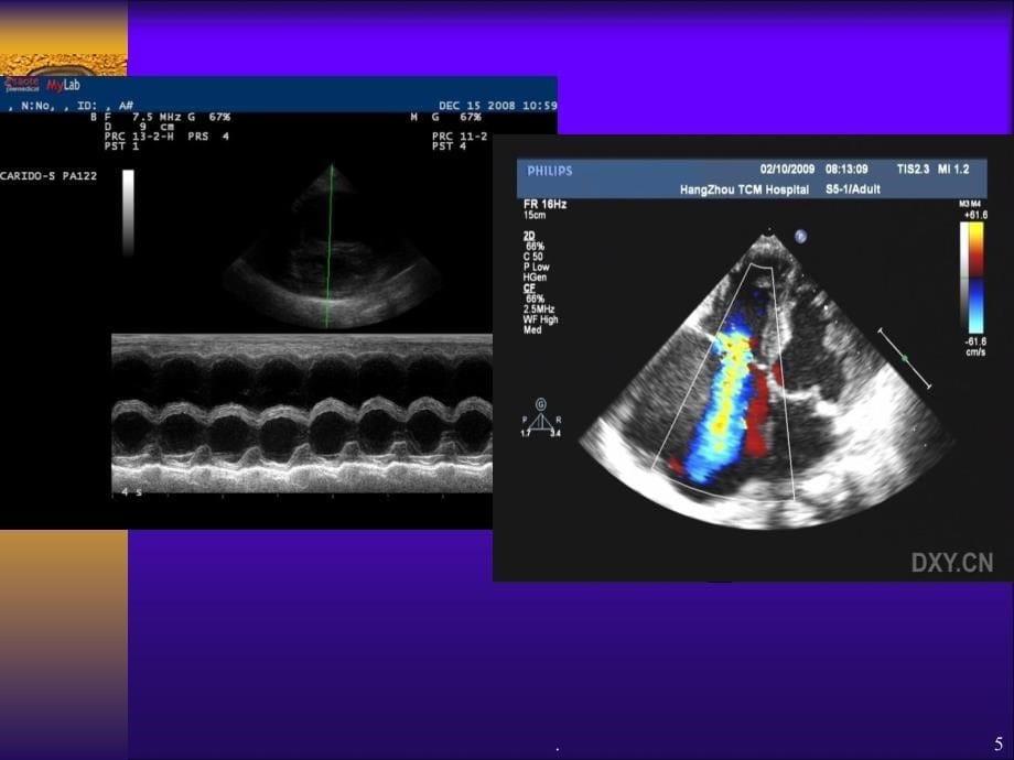 心脏彩超的临床应用精品PPT课件_第5页