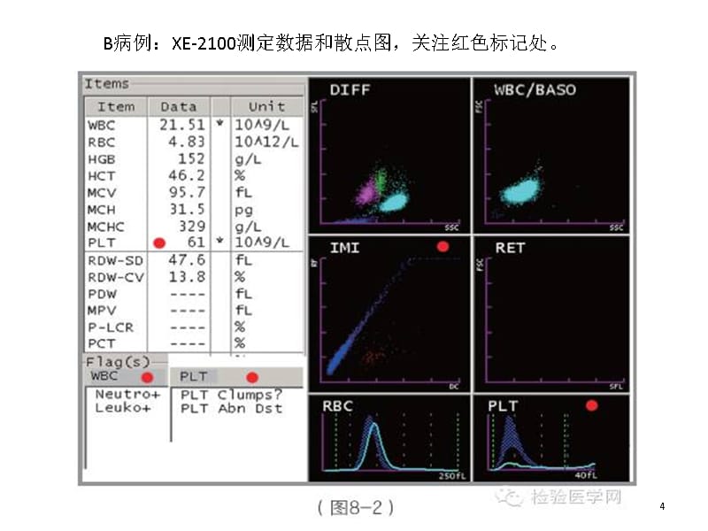 EDTA依赖性假性血小板减少PPT课件_第4页