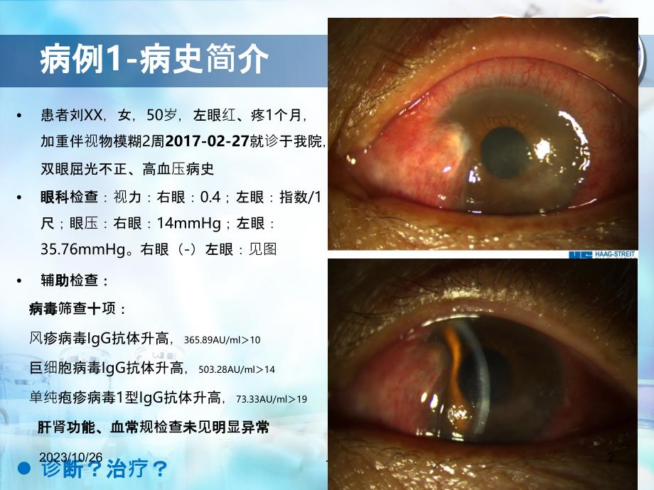 角膜内皮炎的诊断与治疗体会PPT课件_第2页