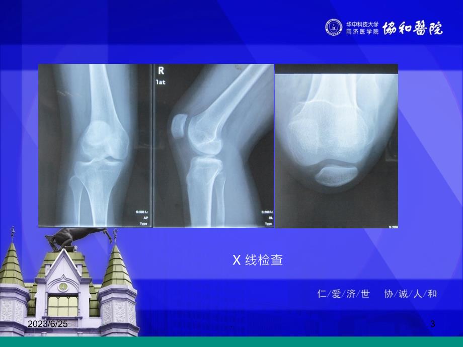 髌骨脱位诊断分型PPT课件_第3页