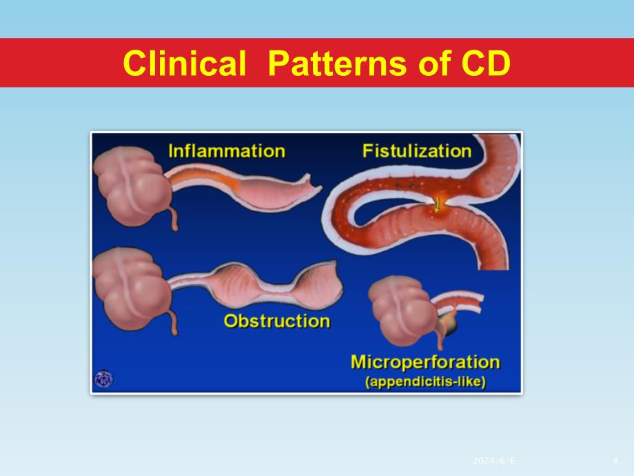 内科学教学资料：二院胃肠科克罗恩病-文档资料课件_第4页