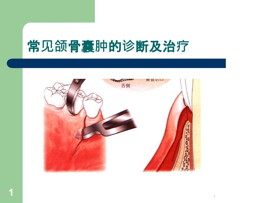 颌骨囊肿精品PPT课件_第1页