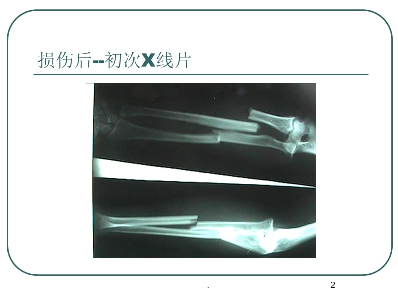 陈旧性孟氏骨折PPT课件_第2页