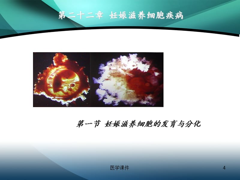 《妇产科学》第二版配套--妊娠滋养细胞疾病--PPT课件_第4页