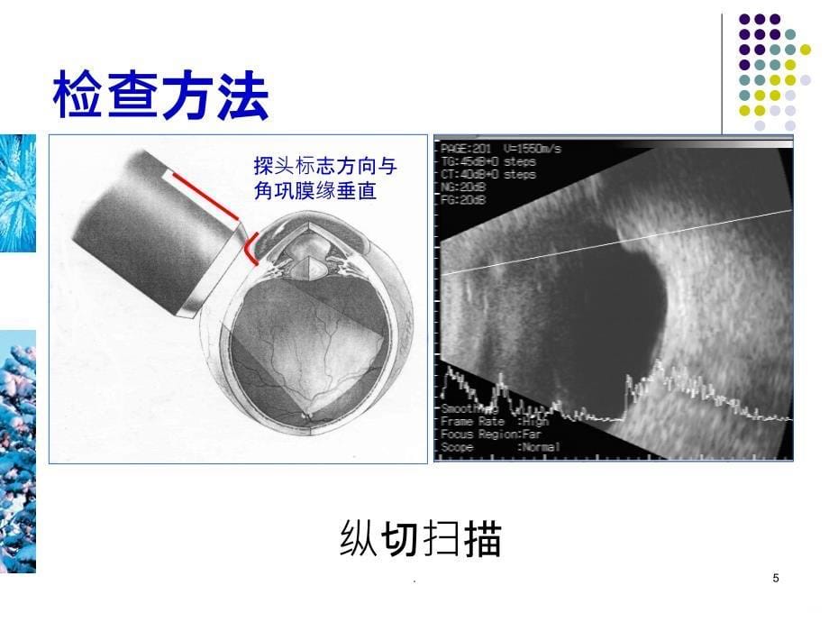 眼部疾病的超声诊断PPT课件_第5页