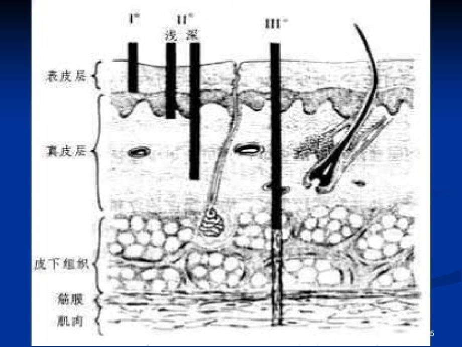 营养与烧伤PPT课件_第5页