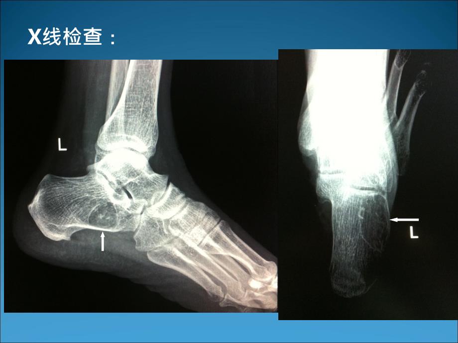 骨脂肪瘤PPT课件_第3页