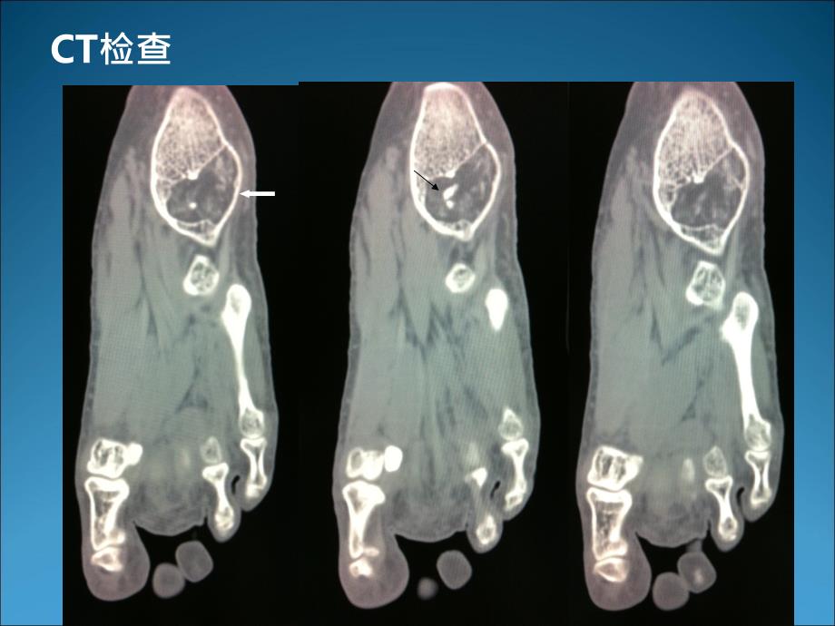 骨脂肪瘤PPT课件_第4页