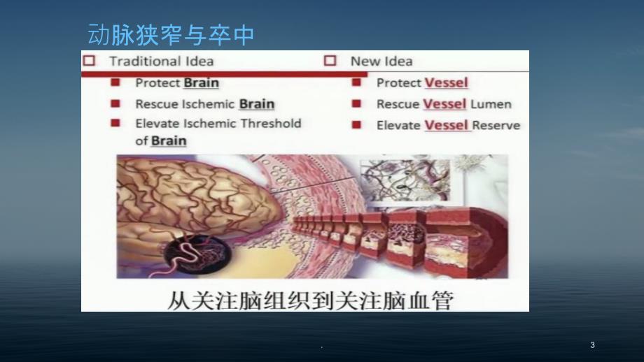 颈动脉狭窄概述与病例PPT课件_第3页