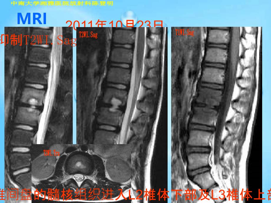 许莫氏结节典型影像PPT课件_第4页