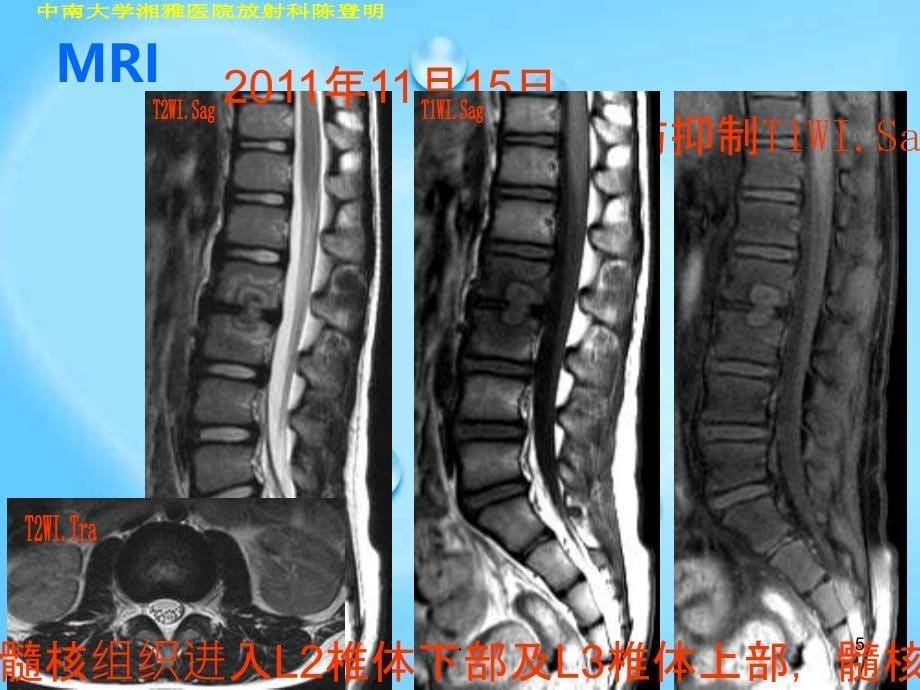 许莫氏结节典型影像PPT课件_第5页