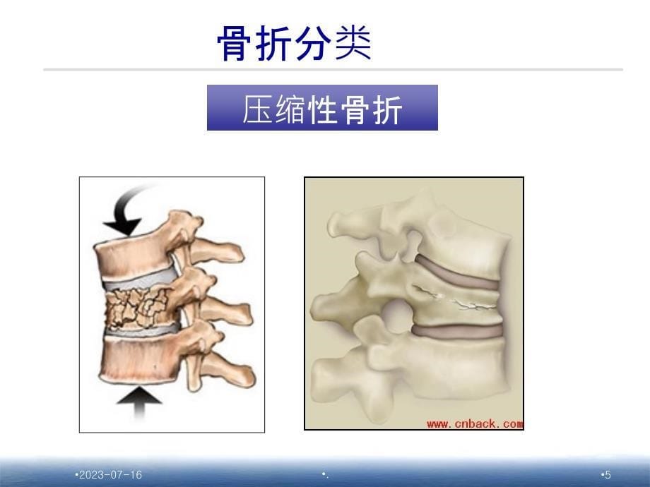 胸腰椎骨折护理_查房PPT课件_第5页