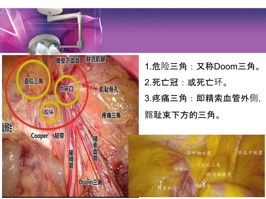 腹腔镜下疝气修补术PPT课件_第4页