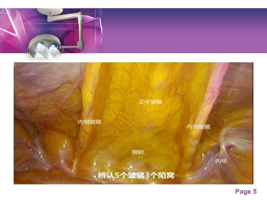 腹腔镜下疝气修补术PPT课件_第5页