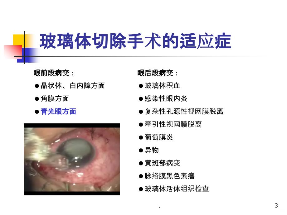 玻璃体切除手术PPT课件_第3页