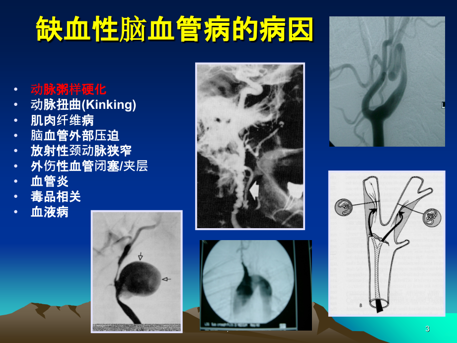 病因分型成都精品PPT课件_第3页