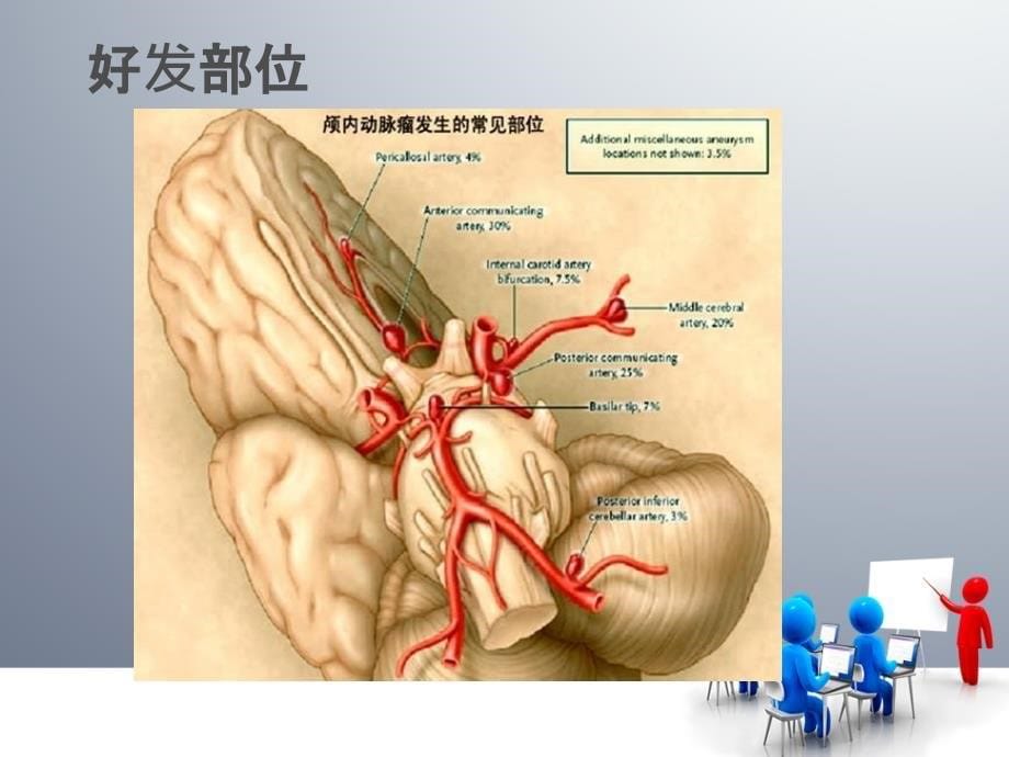 动脉瘤介入手术治疗PPT课件_第5页