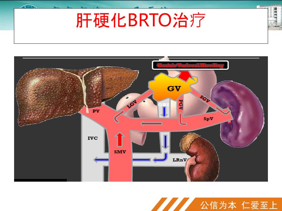 肝硬化门脉高压症的BRTO治疗PPT课件_第4页