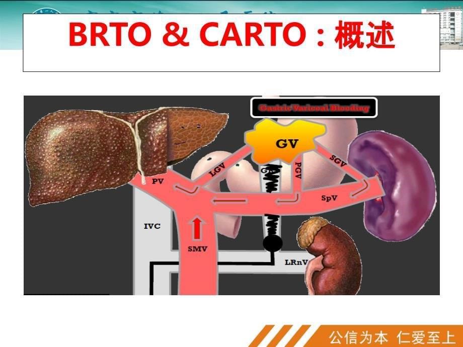肝硬化门脉高压症的BRTO治疗PPT课件_第5页