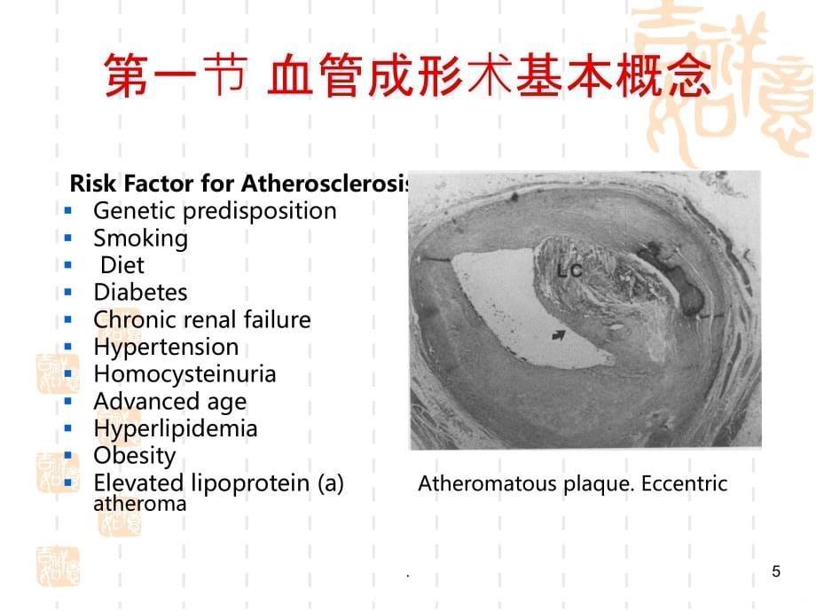 血管成形术及支架植入术精品PPT课件_第5页