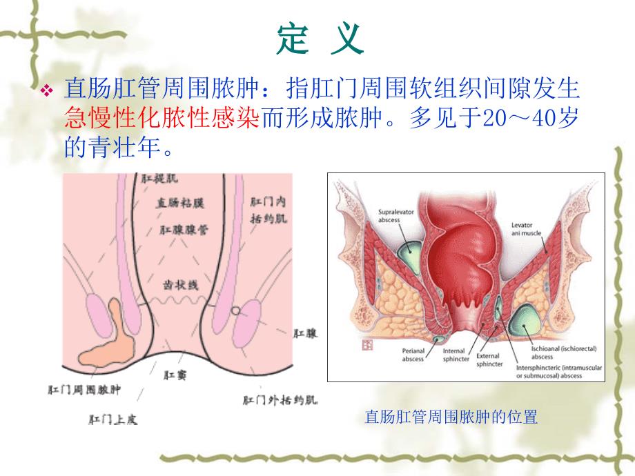 肛周脓肿ppt....ppt_第3页