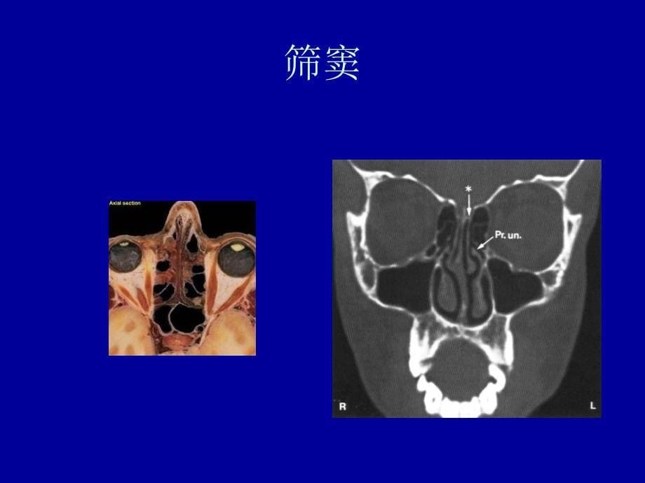 鼻窦炎董瑜讲义教材_第5页