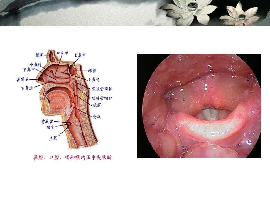 喉炎病人的护理PPT课件_第3页