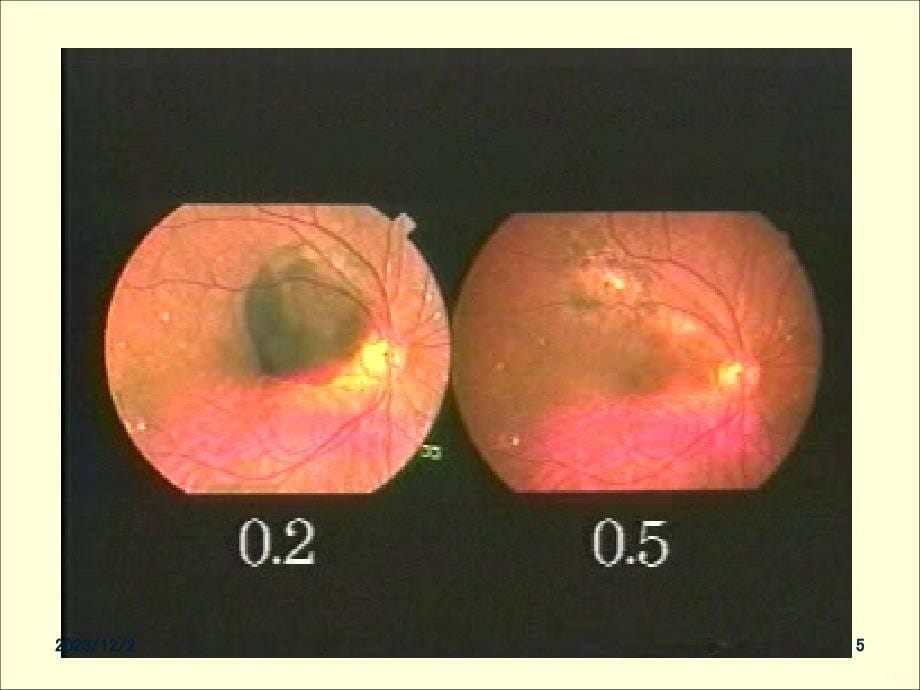 手术治疗视网膜下出血PPT课件_第5页