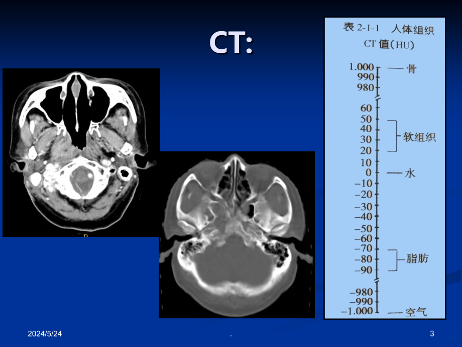 鼻咽癌的CT与MRI诊断PPT课件_第3页