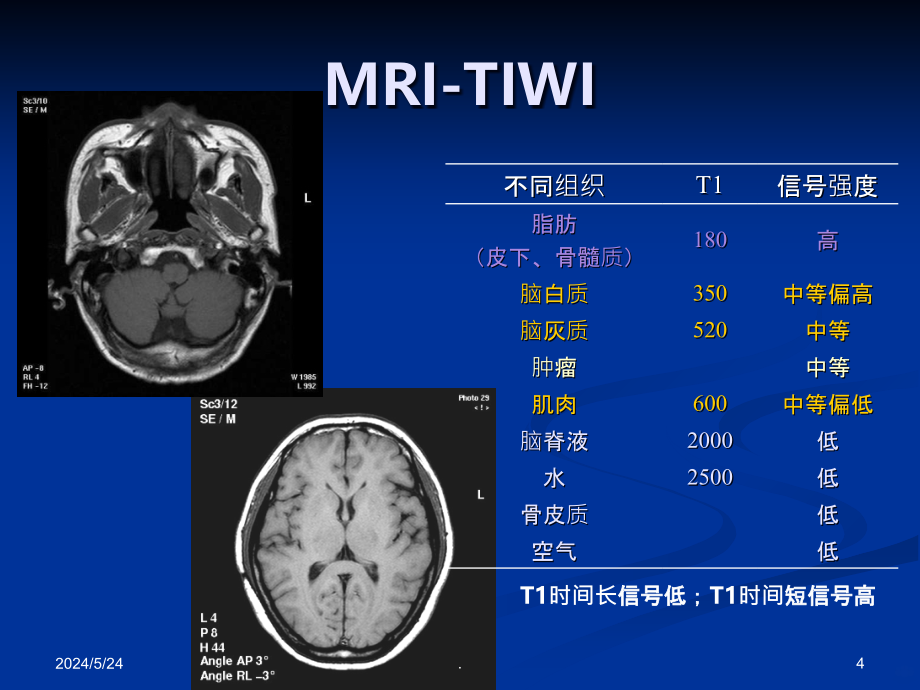 鼻咽癌的CT与MRI诊断PPT课件_第4页