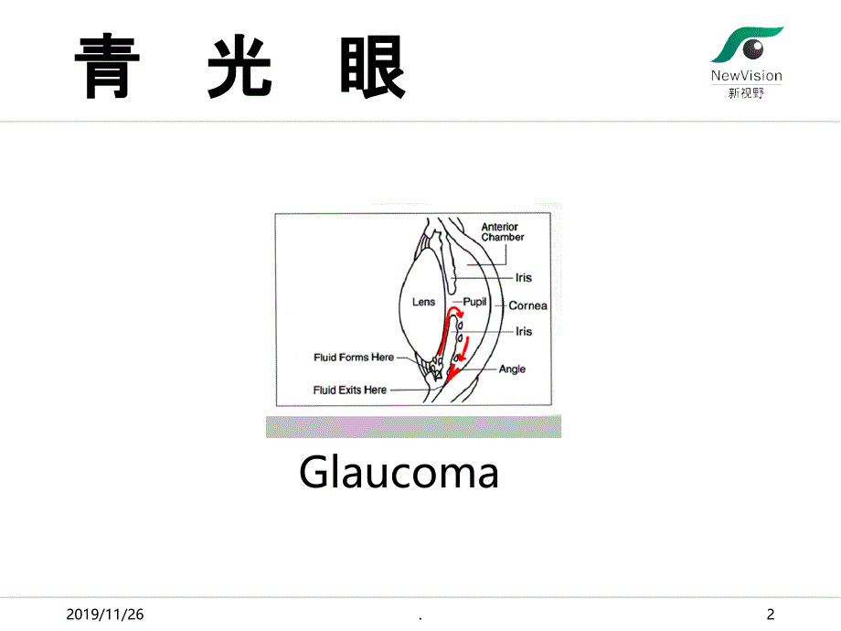 青光眼基础知识PPT课件_第2页