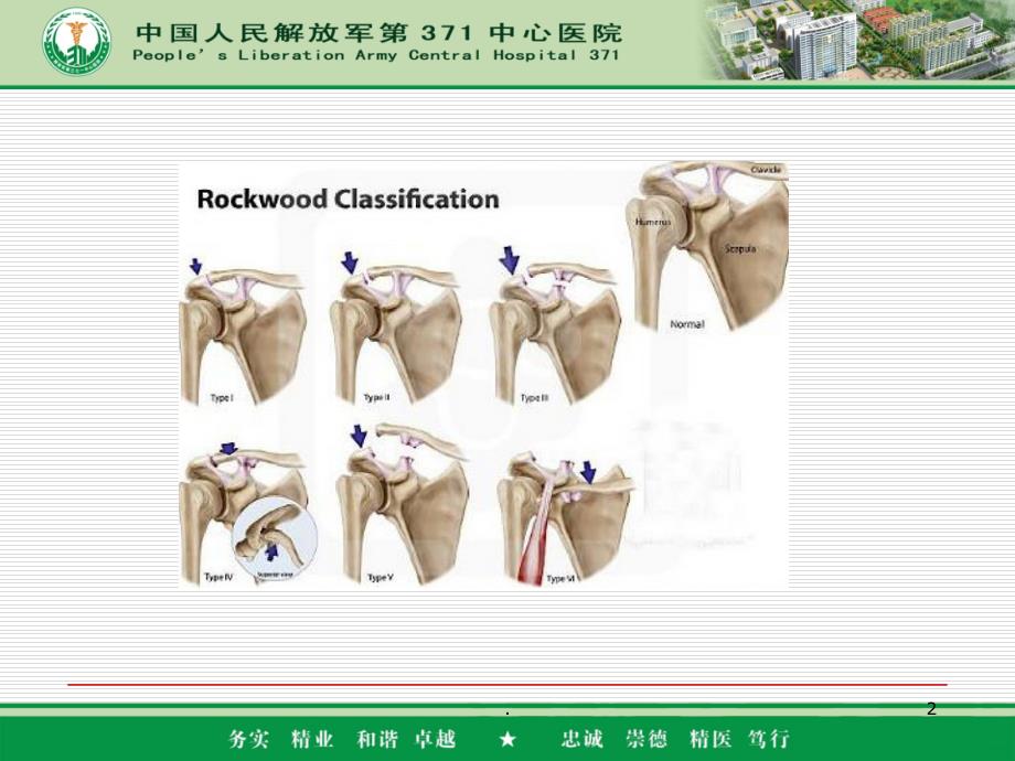 肩锁关节脱位分型和固定方式PPT课件_第2页