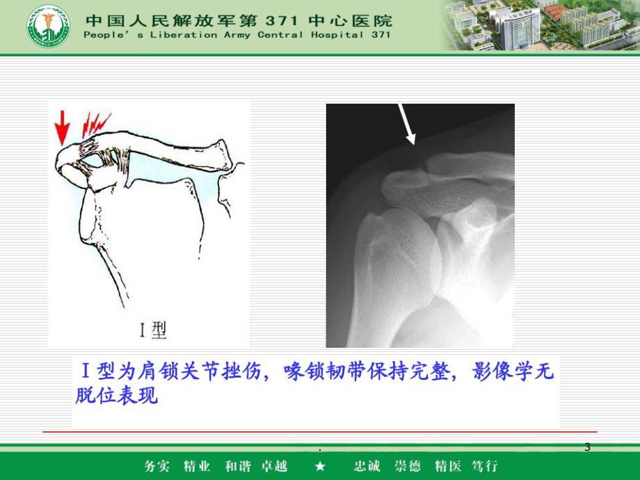 肩锁关节脱位分型和固定方式PPT课件_第3页