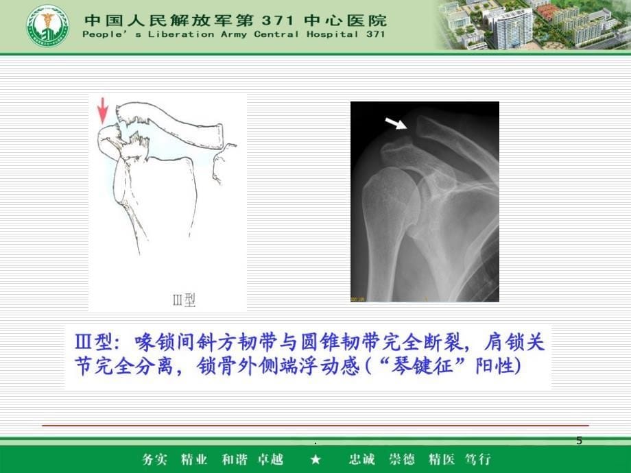 肩锁关节脱位分型和固定方式PPT课件_第5页