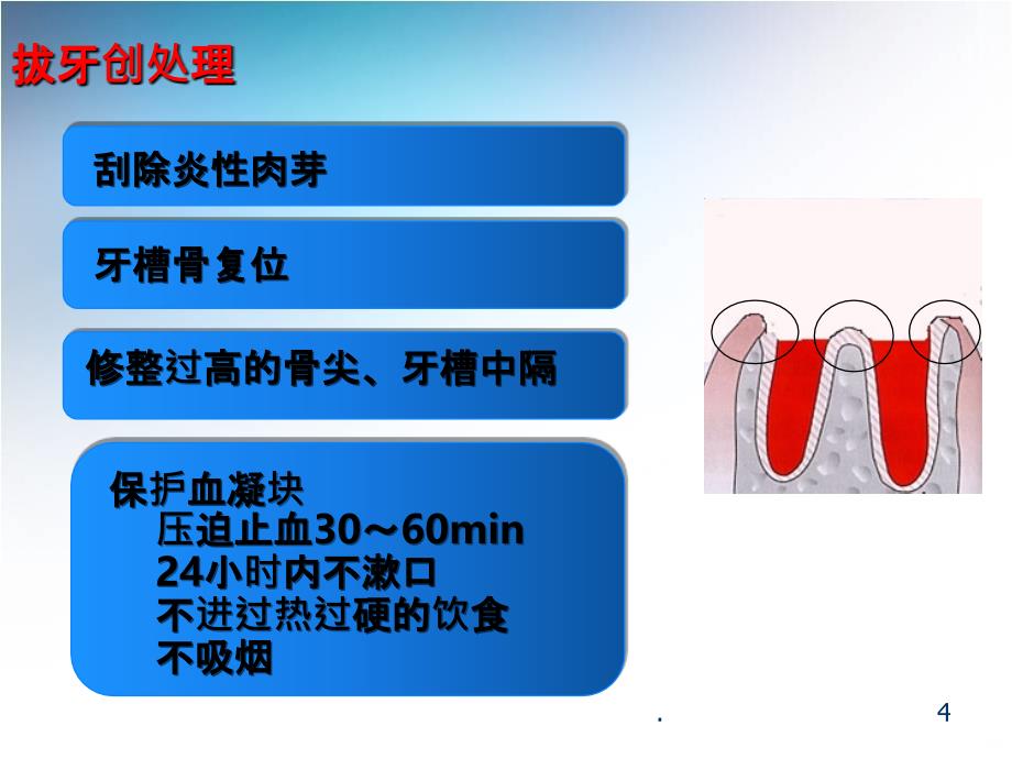 拔牙并发症及拔牙创愈合PPT课件_第4页