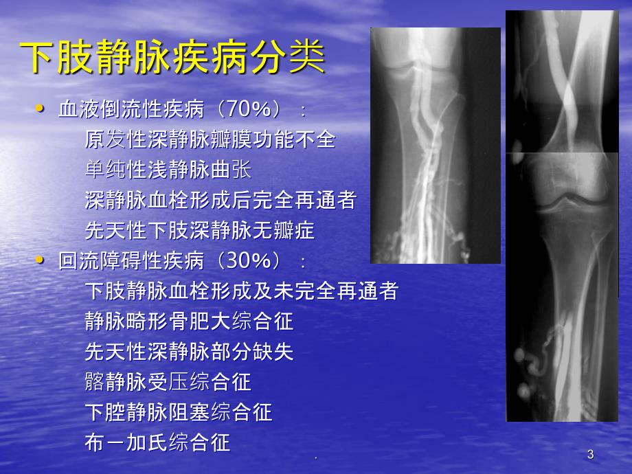 下肢静脉造影方法PPT课件_第3页