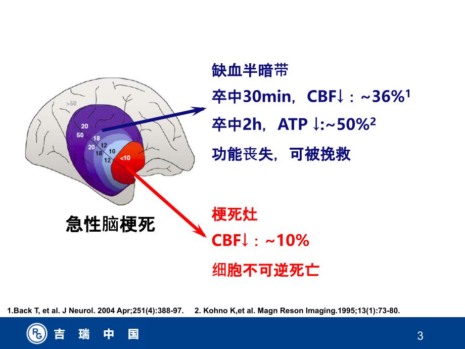 挽救缺血半暗带ppt课件_第3页